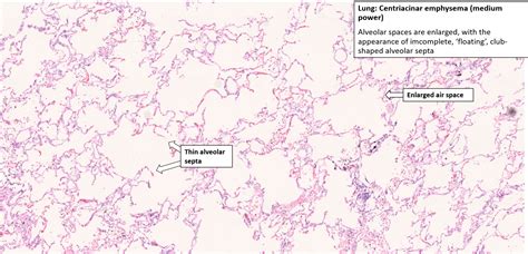 Lung Emphysema Nus Pathweb Nus Pathweb