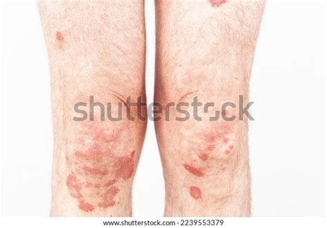 Eczema On Legs Allergy Spots Red Stock Photo 2239553379 | Shutterstock