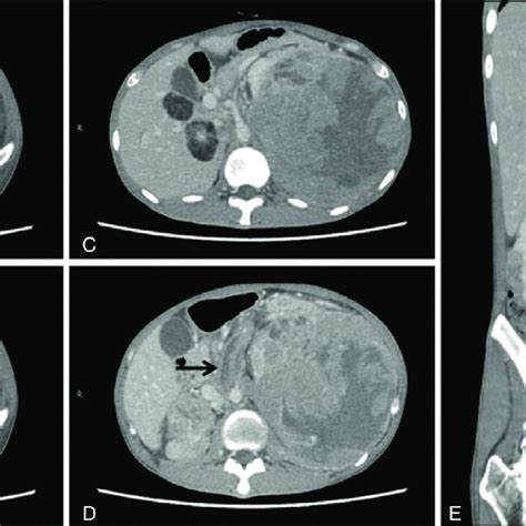 Abdominal Contrast Enhanced CT Images Of EAML In A 24 Year Old Man A