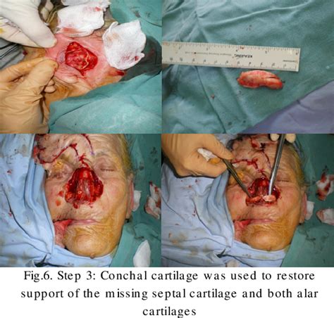 Figure From Complex Nasal Reconstruction Using Locoregional Flaps