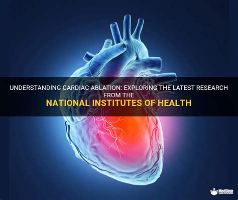 Understanding Cardiac Ablation Exploring The Latest Research From The