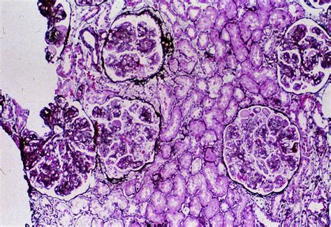 AJKD Atlas Of Renal Pathology Membranoproliferative Glomerulonephritis