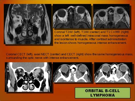 Diagnostic Imaging In Head And Neck Lymphoma Semantic Scholar