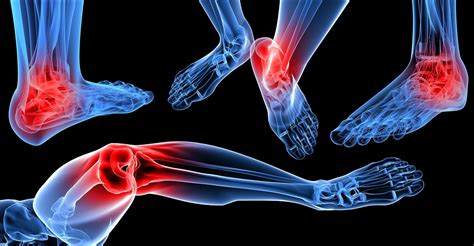 Foot Arthritis Treatment Alberta: The Foot Institute