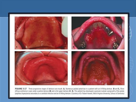 Denture Induced Lesions Aarti Dubey Ppt