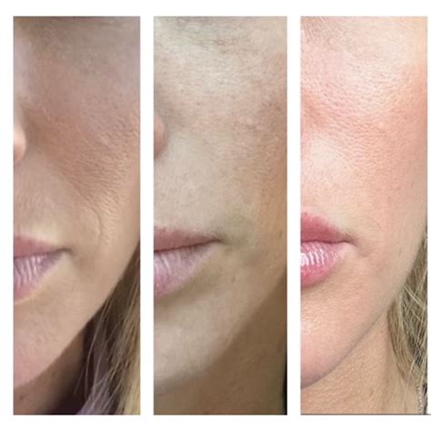 Before After Results Gallery Jane Olson Md Cosmetic Plastic