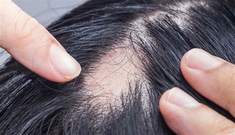 10 Home Remedies To Regrow Hair On Bald Patches