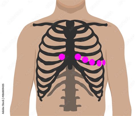 Chest leads placement. Ecg electrode position Stock Vector | Adobe Stock