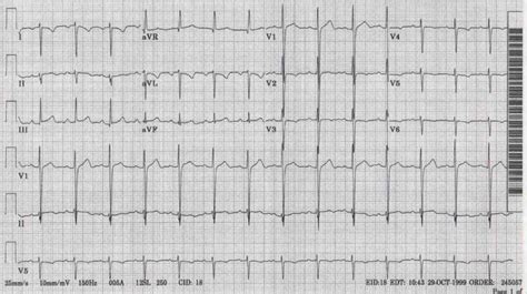 Dextrocardia - Medicalopedia