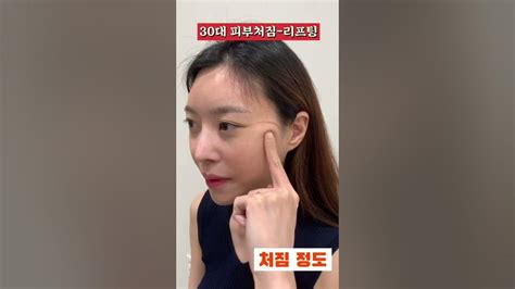 30대 미니거상 한달 후 팔자주름 볼처짐 입가주름 얼굴처짐 Facelifts 모즈클리닉 모든 시술수술은 부작용이