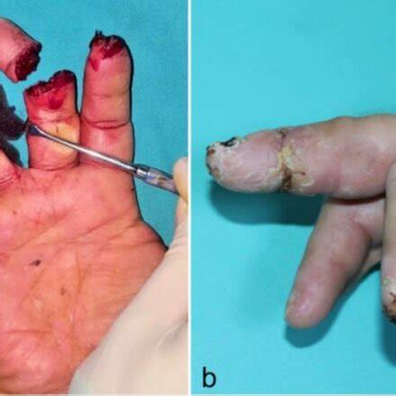 Case Preoperative A And Postoperative B Images Of The Patient