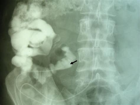 Enterocutaneous Fistula Due To Mesh Fixation In The Repair Of Lateral