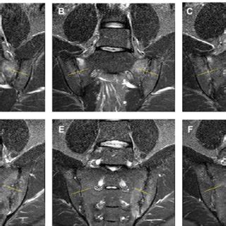 Radiography Of Sacroiliac Joint Ferguson View Showing Right