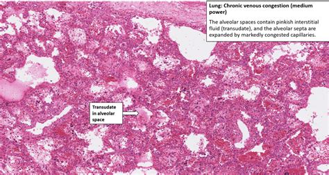 Lung Chronic Venous Congestion Brown Induration Nus Pathweb