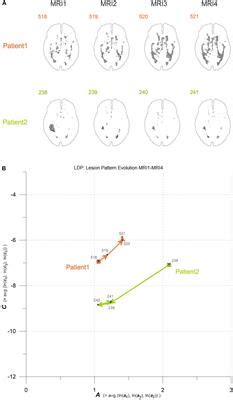 Frontiers Geostatistical Analysis Of White Matter Lesions In Multiple