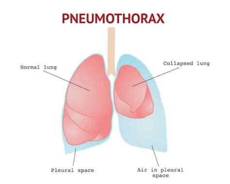 What Causes A Collapsed Lung Senior Outlook Today