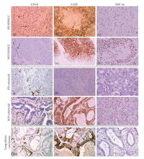 Photomicrographs Of Tumor Tissue Microarrays TMAs From Surgical