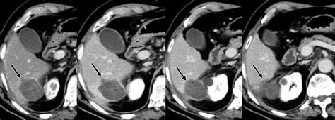 Effectiveness Safety And Local Progression After Percutaneous Laser