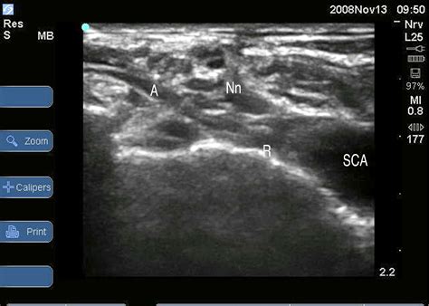 figure   brachial plexus anatomy normal  variant semantic scholar