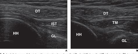 Figure 7 From Sonography Of The Teres Minor A Study Of Cadavers