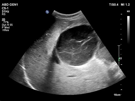 Abdominal Lymphoma Image