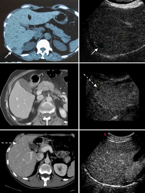 Comparison Of Ct Left Column And Contrast Enhanced Us Ceus Right