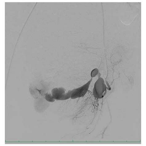 A Selective Left Uterine Artery Angiogram Reveals A Pseudoaneurysm With