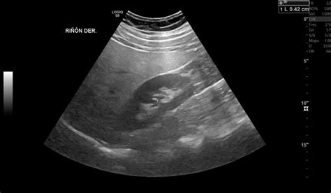 Ultrasonido Vesical Centro De Imagenolog A Y Terap Utica Altabrisa