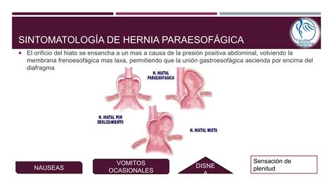 Hernias Diafragm Ticas Ppt