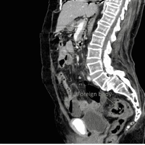 Cect Of The Abdomen And Pelvis Sagittal View Showing Visible Partial Download Scientific