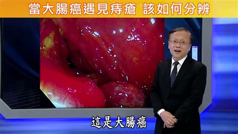 【當大腸癌遇見痔瘡 該如何分辨】【大愛醫生館精選】 Youtube