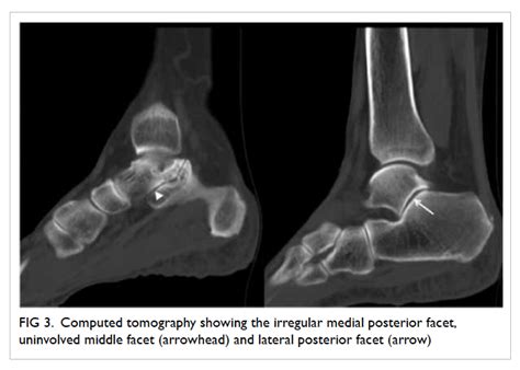 Talocalcaneal Coalition Mri