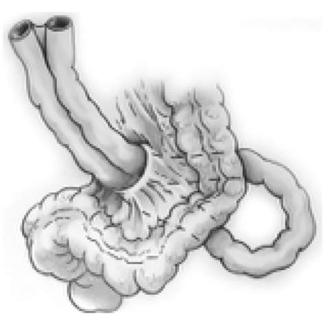 Sigmoid mesocolon hernia is classified into 3 types: (a) intersigmoid... | Download Scientific ...