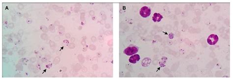 Thin blood smear of cerebral malaria and renal malaria groups. (A) Thin ...