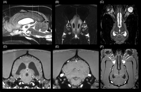 Sagittal T2W Sequence Showing Moderate Dilatation Of The Lateral And