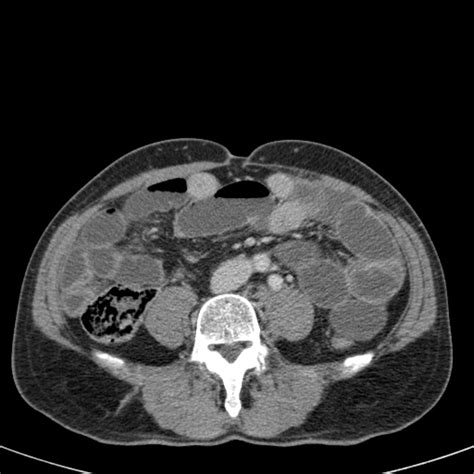 The Radiology Assistant Closed Loop Obstruction In Small Bowel Obstruction