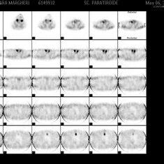 Tc M Sestamibi Scan Showing A Main Pathologic Increased Uptake On