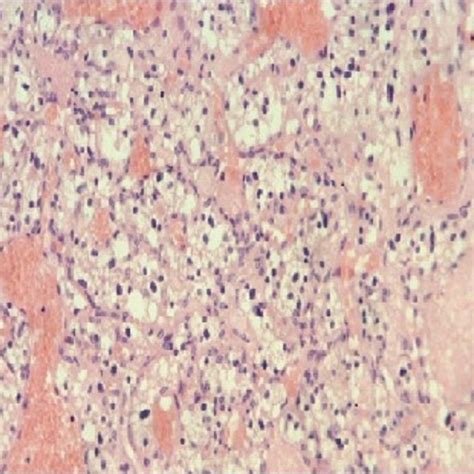 Histopathological Examination Of A Hemangioblastoma Note The Extensive