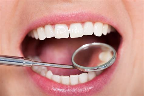 How Long Do Dental Crowns Really Last Aristo Dental