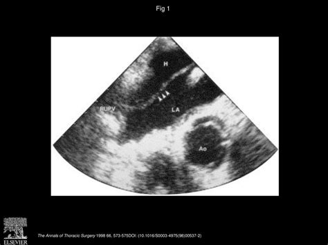 Transesophageal Echocardiographic Evaluation Of Perioperative Coronary