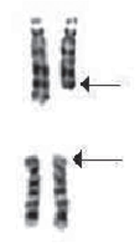 Partial Karyotype Showing A Terminal Deletion Of Chromosome 13 At Band Download Scientific