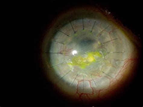 Corneal Transplant