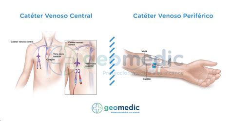 Extracci N De Sangre Con Cat Ter Venoso Central Procedimiento Y