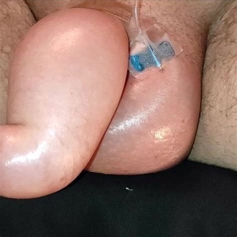 Saline Infusion Scrotum Again Free Again Porn 5b Xhamster Xhamster