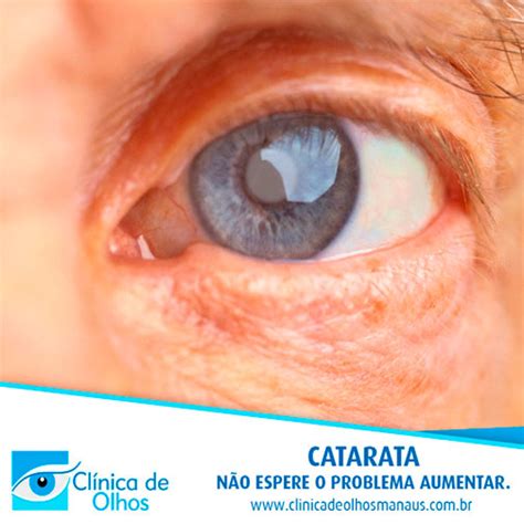 Catarata Cl Nica De Olhos Manaus