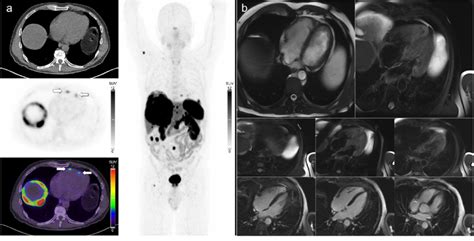 A Ga Ga Dotatate Pet Ct Images In A Patient With Metastatic