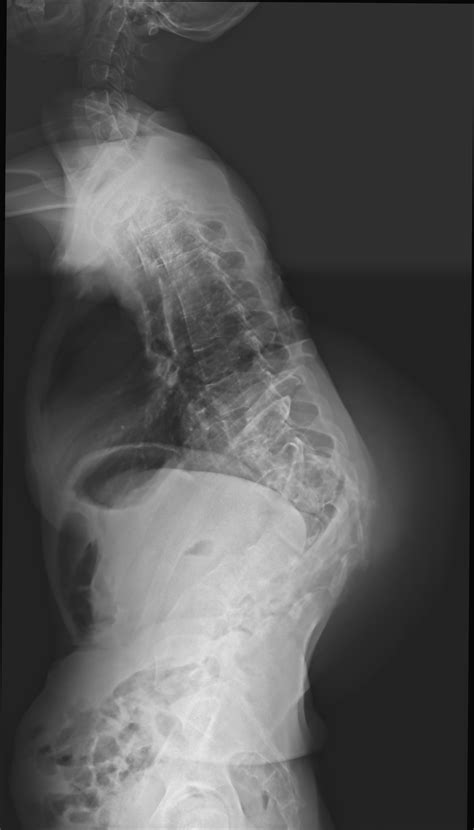 Plexiform Neurofibromatosis Of The Spine Image Radiopaedia Org