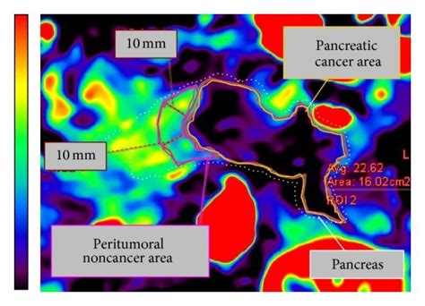 Analysis Of Pancreatic Perfusion Image We Analyzed The Ct Image