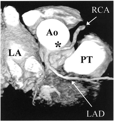 Malignant Right Coronary Artery Anomaly Detected By Magnetic Resonance