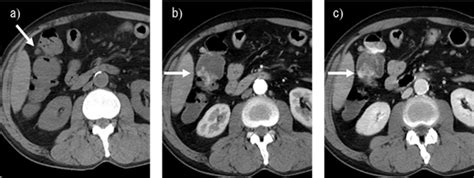 Usefulness Of Contrast Enhanced Ct On Arrival In Colonic Diverticular